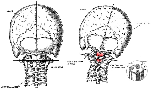 Nucca Chiropractor